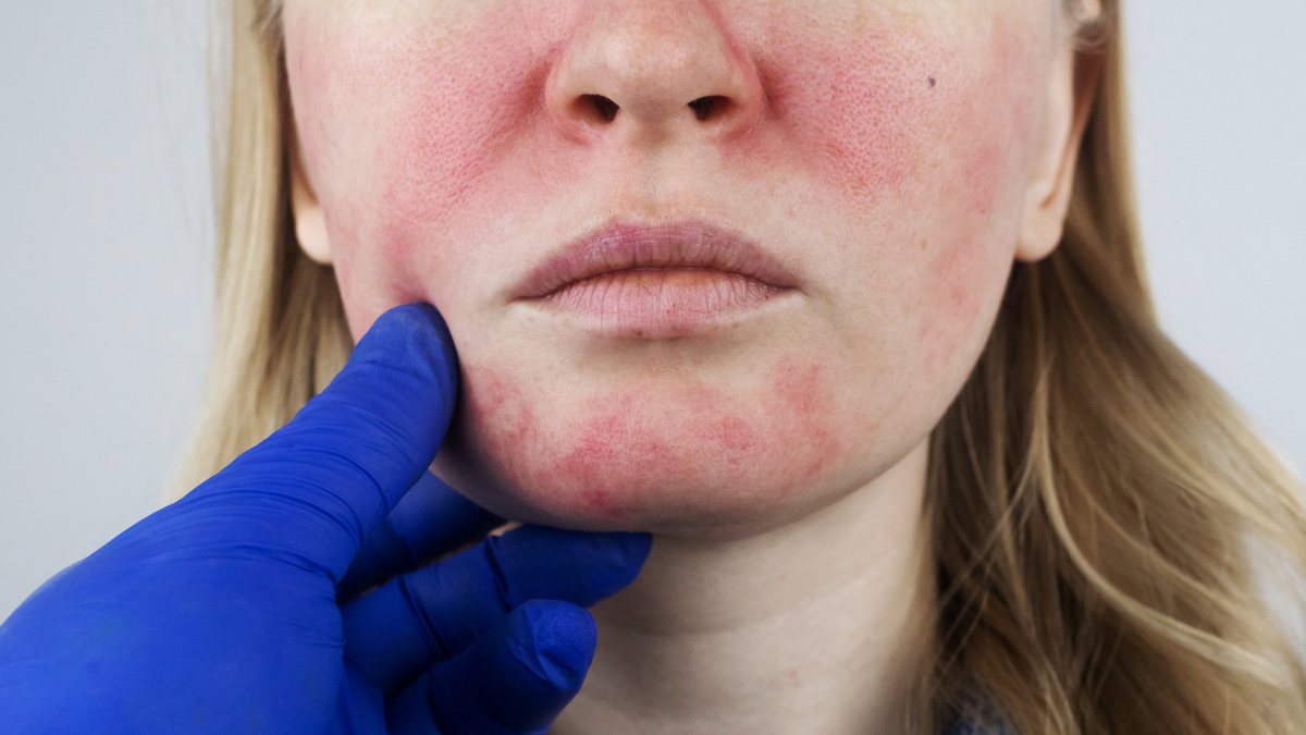 Close-up of facial redness on cheeks and chin